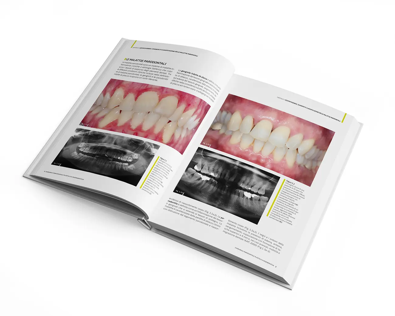 Carrera, impaginazione book chirurgia parodontale plastica e rigenerativa per edra